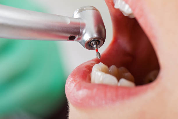 Best Emergency Dental Extractions in Creston, IA